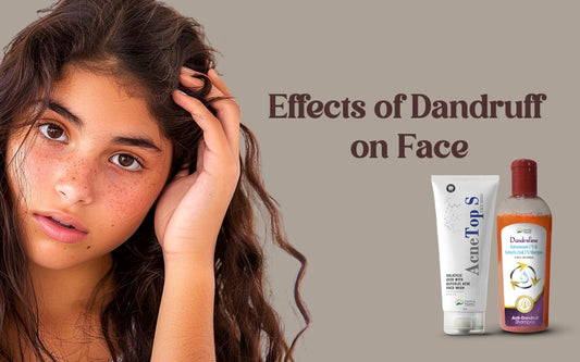 Effects of Dandruff on Face