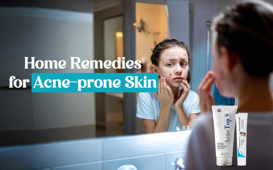 Home Remedies for Acne-prone Skin