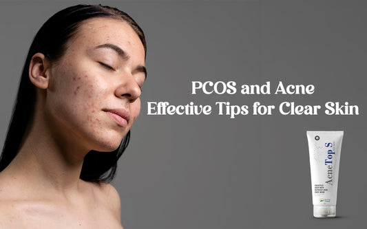 PCOS and Acne: Effective Tips 